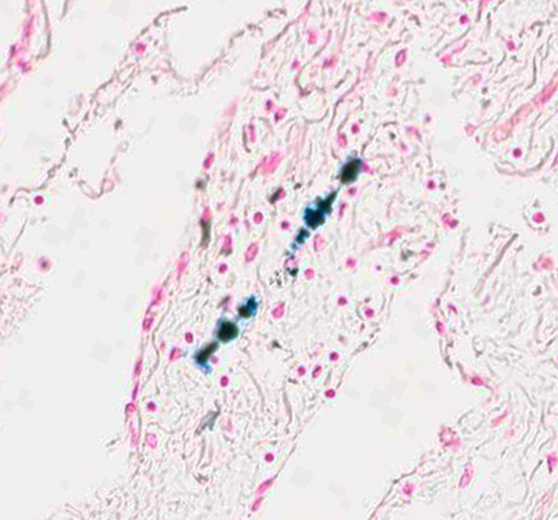 Figure 6_Asbestos body